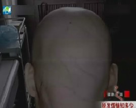 脱发烦恼知多少