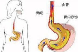 反酸烧心巧应对（上）
